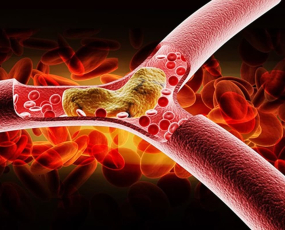 Máu nhiễm mỡ kiêng ăn gì? Ăn gì để giảm mỡ máu?